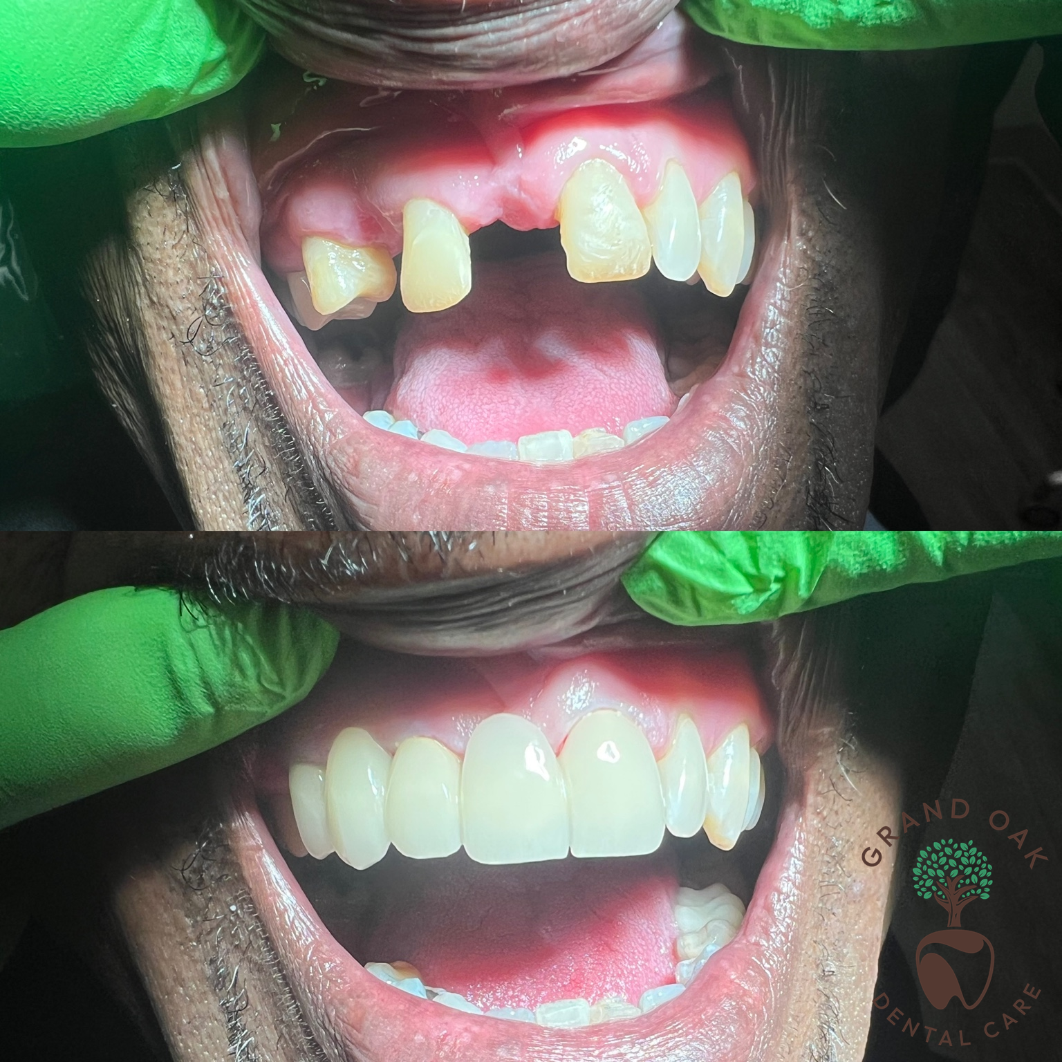 A Whole New Smile with Customized Zirconia